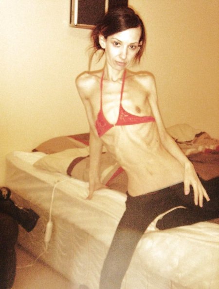 Naked skinny anorexics