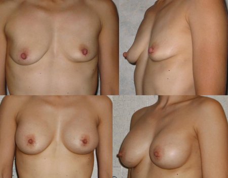 Naked boobs of first size