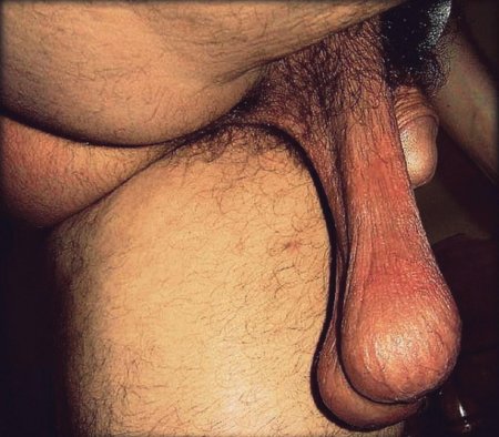 Old saggy scrotum